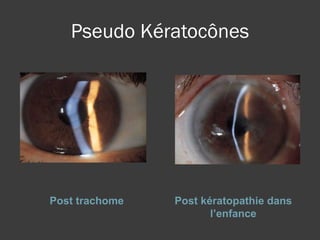 Pseudo Kératocônes Post trachome Post kératopathie dans l’enfance 