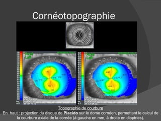 Cornéotopographie Topographie de courbure En  haut : projection du disque de  Placido  sur le dome cornéen, permettant le calcul de la courbure axiale de la cornée (à gauche en mm, à droite en dioptries). 