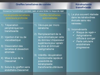 Greffe lamellaire de cornée Intérêt Conserver l’endothélium cornéen, sain, et ainsi limiter le risque de rejet 