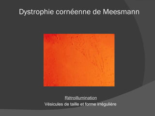 Dystrophie cornéenne de Meesmann Rétroillumination Vésicules de taille et forme irrégulière 