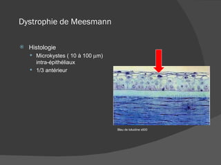 Dystrophie de Meesmann Histologie Microkystes ( 10 à 100   m) intra-épithéliaux 1/3 antérieur Bleu de toluidine x600 