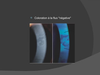 Coloration à la fluo "négative" 