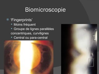 Biomicroscopie ‘ Fingerprints’ Moins fréquent Groupe de lignes parallèles  concentriques, curvilignes Central ou para-central 