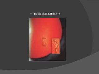 Rétro-illumination+++ 
