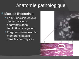 Anatomie pathologique Maps et fingerprints La MB épaissie envoie des expansions aberrantes dans l’épithélium sus-jacent Fragments inversés de membrane basale dans les microkystes 