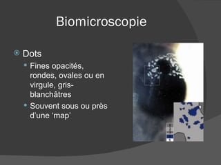 Biomicroscopie Dots Fines opacités, rondes, ovales ou en virgule, gris-blanchâtres Souvent sous ou près d’une ‘map’ 