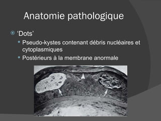 Anatomie pathologique ‘ Dots’ Pseudo-kystes contenant débris nucléaires et cytoplasmiques Postérieurs à la membrane anormale 