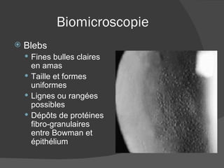 Biomicroscopie Blebs Fines bulles claires en amas Taille et formes uniformes Lignes ou rangées possibles Dépôts de protéines fibro-granulaires entre Bowman et épithélium 