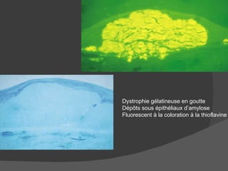 Dystrophie gélatineuse en goutte Dépôts sous épithéliaux d’amylose Fluorescent à la coloration à la thioflavine  