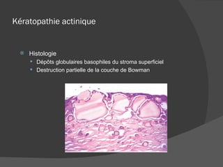 Kératopathie actinique Histologie Dépôts globulaires basophiles du stroma superficiel Destruction partielle de la couche de Bowman 