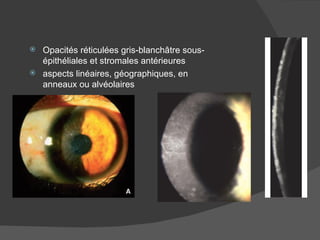 Opacités réticulées gris-blanchâtre sous-épithéliales et stromales antérieures aspects linéaires, géographiques, en anneaux ou alvéolaires 