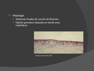 Histologie Absences focales de couche de Bowman Dépôts granuleux disposés en bande sous l’épithélium Hémalun-éosine-safran x430 