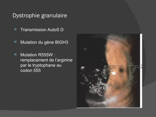 Dystrophie granulaire Transmission AutoS D Mutation du gène BIGH3 Mutation R555W : remplacement de l’arginine par le tryptophane au codon 555 