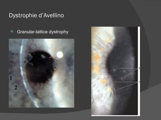 Dystrophie d’Avellino Granular-lattice dystrophy 