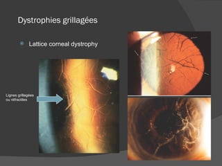 Dystrophies grillagées Lattice corneal dystrophy Lignes grillagées ou réfractiles 