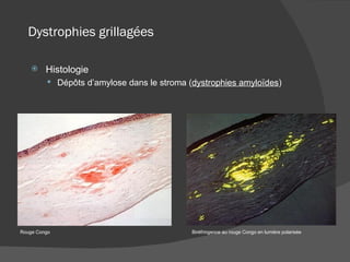 Dystrophies grillagées Histologie Dépôts d’amylose dans le stroma ( dystrophies amyloïdes ) Rouge Congo Biréfringence au rouge Congo en lumière polarisée 