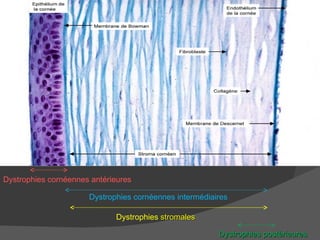 Dystrophies cornéennes antérieures Dystrophies cornéennes intermédiaires Dystrophies  stromales Dystrophies postérieures 