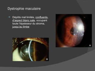 Dystrophie maculaire Dépôts mal limités,  confluents ,  d’aspect blanc sale , occupant toute l’épaisseur du stroma,  jusqu’au limbe 