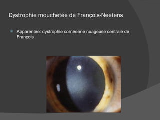 Dystrophie mouchetée de François-Neetens Apparentée: dystrophie cornéenne nuageuse centrale de François 