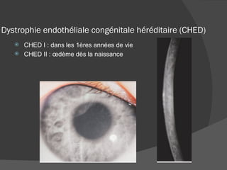 Dystrophie endothéliale congénitale héréditaire (CHED) CHED I : dans les 1ères années de vie CHED II : œdème dès la naissance 