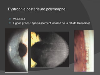 Dystrophie postérieure polymorphe Vésicules Lignes grises : épaississement localisé de la mb de Descemet 