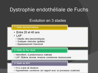 Dystrophie endothéliale de Fuchs Evolution en 3 stades 