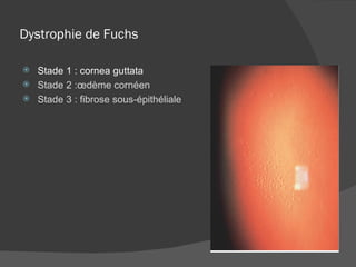 Dystrophie de Fuchs Stade 1 : cornea guttata Stade 2 :œdème cornéen Stade 3 : fibrose sous-épithéliale 