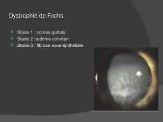 Dystrophie de Fuchs Stade 1 : cornea guttata Stade 2 :œdème cornéen Stade 3 : fibrose sous-épithéliale 