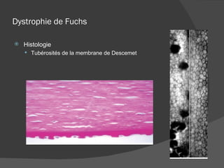 Dystrophie de Fuchs Histologie Tubérosités de la membrane de Descemet 