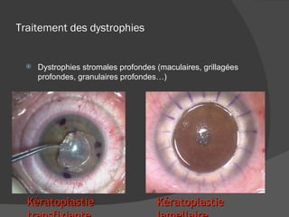 Traitement des dystrophies Dystrophies stromales profondes (maculaires, grillagées profondes, granulaires profondes…) Kératoplastie lamellaire Kératoplastie transfixiante 