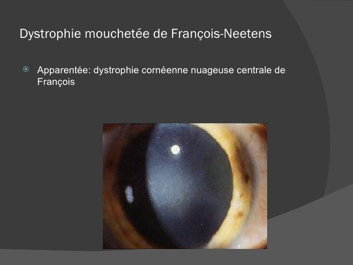 dystrophies-de-cornee
