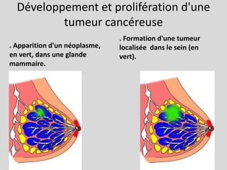Développement et prolifération d'une tumeur cancéreuse. Formation d'une tumeur localisée  dans le sein (en vert).. Apparition d'un néoplasme, en vert, dans une glande mammaire. 