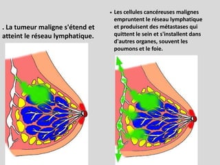 .Les cellules cancéreuses malignes empruntent le réseau lymphatique et produisent des métastases qui quittent le sein et s'installent dans d'autres organes, souvent les poumons et le foie.. La tumeur maligne s'étend et   atteint le réseau lymphatique.