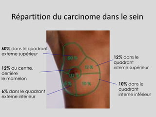 Répartition du carcinome dans le sein 60% dans le quadrantexterne supérieur12% dans le quadrantinterne supérieur12% au centre, derrièrele mamelon10% dans le quadrantinterne inférieur6% dans le quadrantexterne inférieur