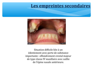 Les empreintes secondaires
Situation difficile liée à un
édentement avec perte de substance
importante : effondrement crestal majeur
de type classe IV maxillaire avec saillie
de l’épine nasale antérieure.
 