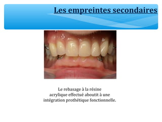 Les empreintes secondaires
Le rebasage à la résine
acrylique effectué aboutit à une
intégration prothétique fonctionnelle.
 