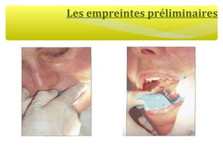 Les empreintes préliminaires
 