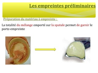 Les empreintes préliminaires
Préparation du matériau à empreinte :
La totalité du mélange emporté sur la spatule permet de garnir le
porte-empreinte
 
