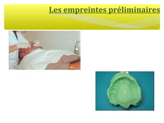 Les empreintes préliminaires
 