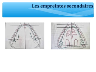 Les empreintes secondaires
 