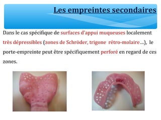 Les empreintes secondaires
Dans le cas spécifique de surfaces d’appui muqueuses localement
très dépressibles (zones de Schröder, trigone rétro-molaire…), le
porte-empreinte peut être spécifiquement perforé en regard de ces
zones.
 