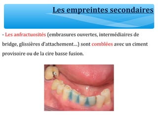 Les empreintes secondaires
- Les anfractuosités (embrasures ouvertes, intermédiaires de
bridge, glissières d’attachement…) sont comblées avec un ciment
provisoire ou de la cire basse fusion.
 