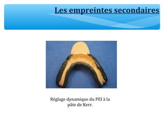 Les empreintes secondaires
Réglage dynamique du PEI à la
pâte de Kerr.
 