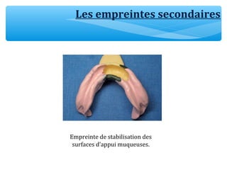 Les empreintes secondaires
Empreinte de stabilisation des
surfaces d’appui muqueuses.
 