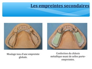 Les empreintes secondaires
Moulage issu d’une empreinte
globale.
Confection du châssis
métallique muni de selles porte-
empreintes.
 