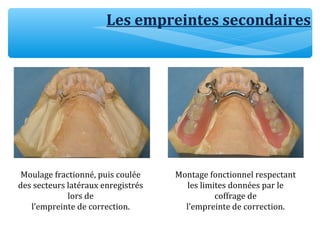Les empreintes secondaires
Moulage fractionné, puis coulée
des secteurs latéraux enregistrés
lors de
l’empreinte de correction.
Montage fonctionnel respectant
les limites données par le
coffrage de
l’empreinte de correction.
 