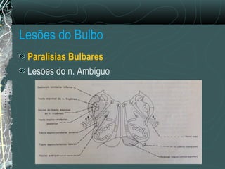 Lesões do Bulbo
Paralisias Bulbares
Lesões do n. Ambíguo
 