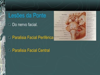 Lesões da Ponte
Do nervo facial.
Paralisia Facial Periférica
Paralisia Facial Central
 
