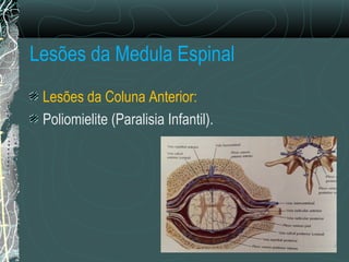 Lesões da Medula Espinal
Lesões da Coluna Anterior:
Poliomielite (Paralisia Infantil).
 