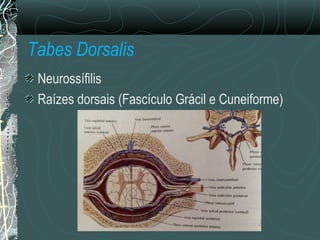 Tabes Dorsalis
Neurossífilis
Raízes dorsais (Fascículo Grácil e Cuneiforme)
 